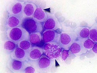 tumor_mikroskop